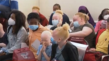 Moçambique – 98% das pessoas com albinismo morrem antes dos 40 anos
