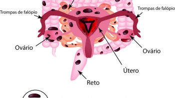 Imagem de VIVA SAÚDE – Endometriose
